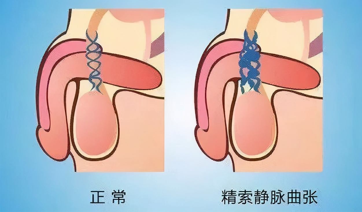 它会导致不育和X功能障碍，十个男的就有一个会得