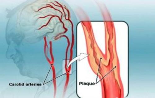 颈部血管越窄，中风风险越高！符合这4个条件之一，马上去医院！