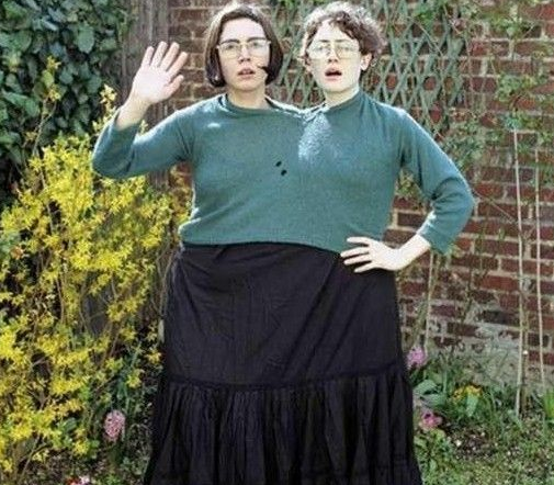 连体人揭秘：其中一个意外去世了，另一个还能