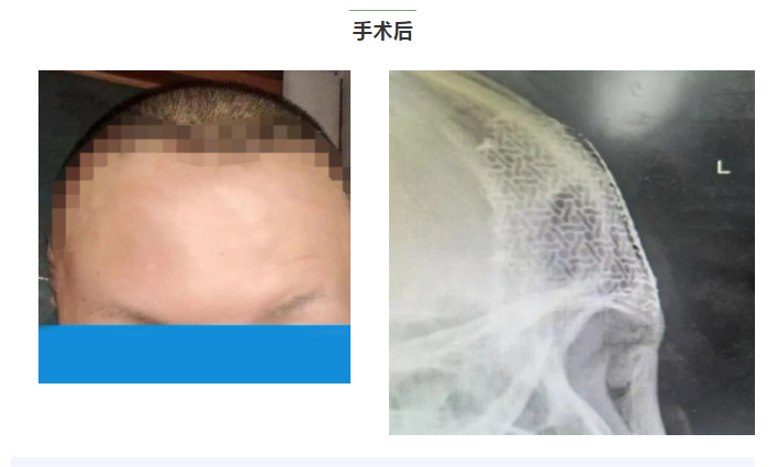 蘭州市第二人民醫(yī)院多學科協(xié)作切除病變重建顏面結構、還患者美麗容顏