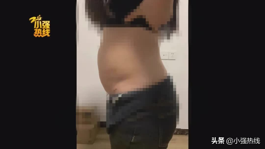 140斤的姑娘抽脂减肥,一次性抽掉4000毫升脂肪