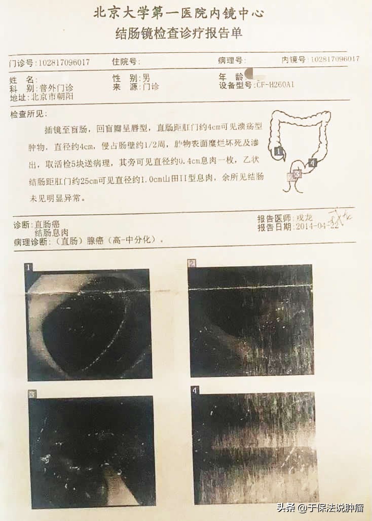 74岁直肠癌患者年龄较大，拒绝手术，经缓释库精准治疗已存活7年