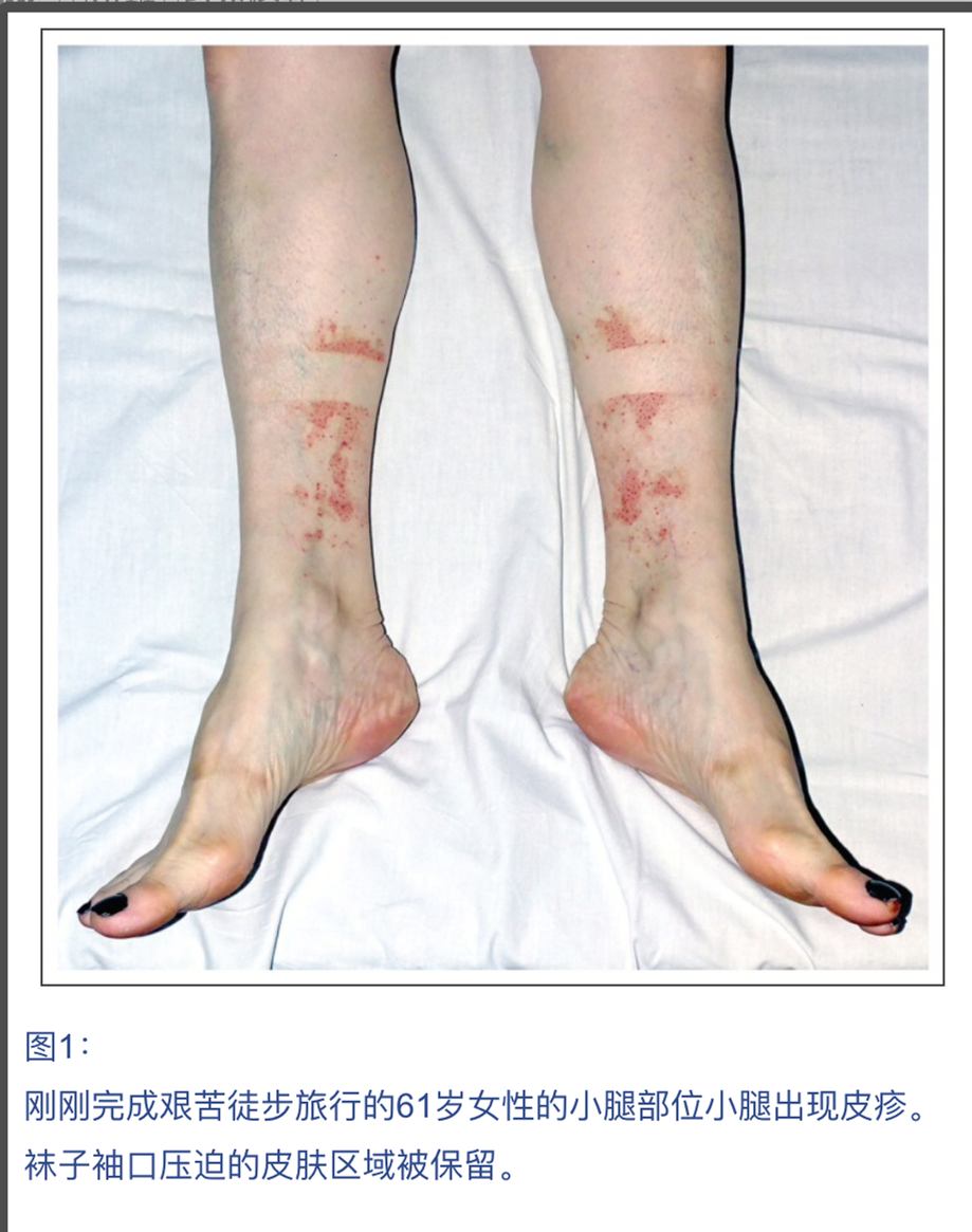 運動還會誘發皮膚血管炎?這是怎麼回事 - 資訊咖
