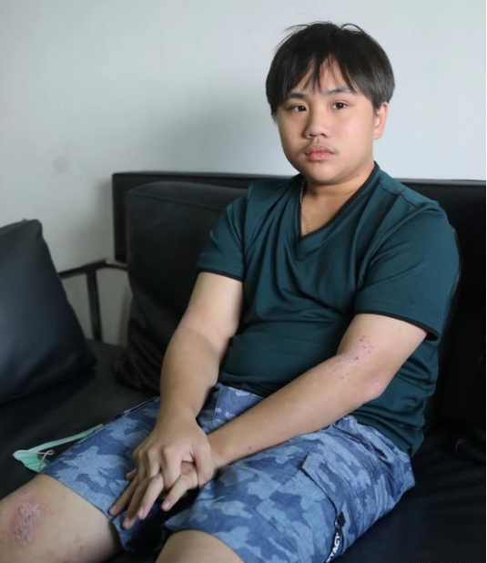 童星小小彬，被亲爸后妈榨干1800万后，皮肤溃烂