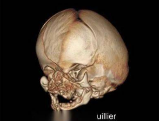 pfeiffer氏综合症为一种非典型的尖头并指(趾)畸形,为基因突变缺陷所