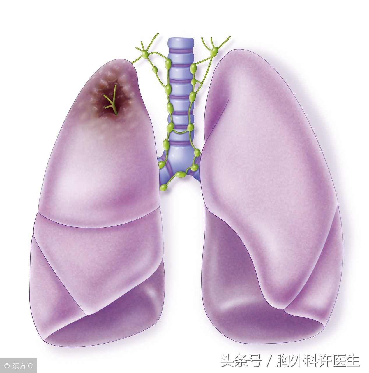 一网打尽“肺结节”，你不得错过的问答！