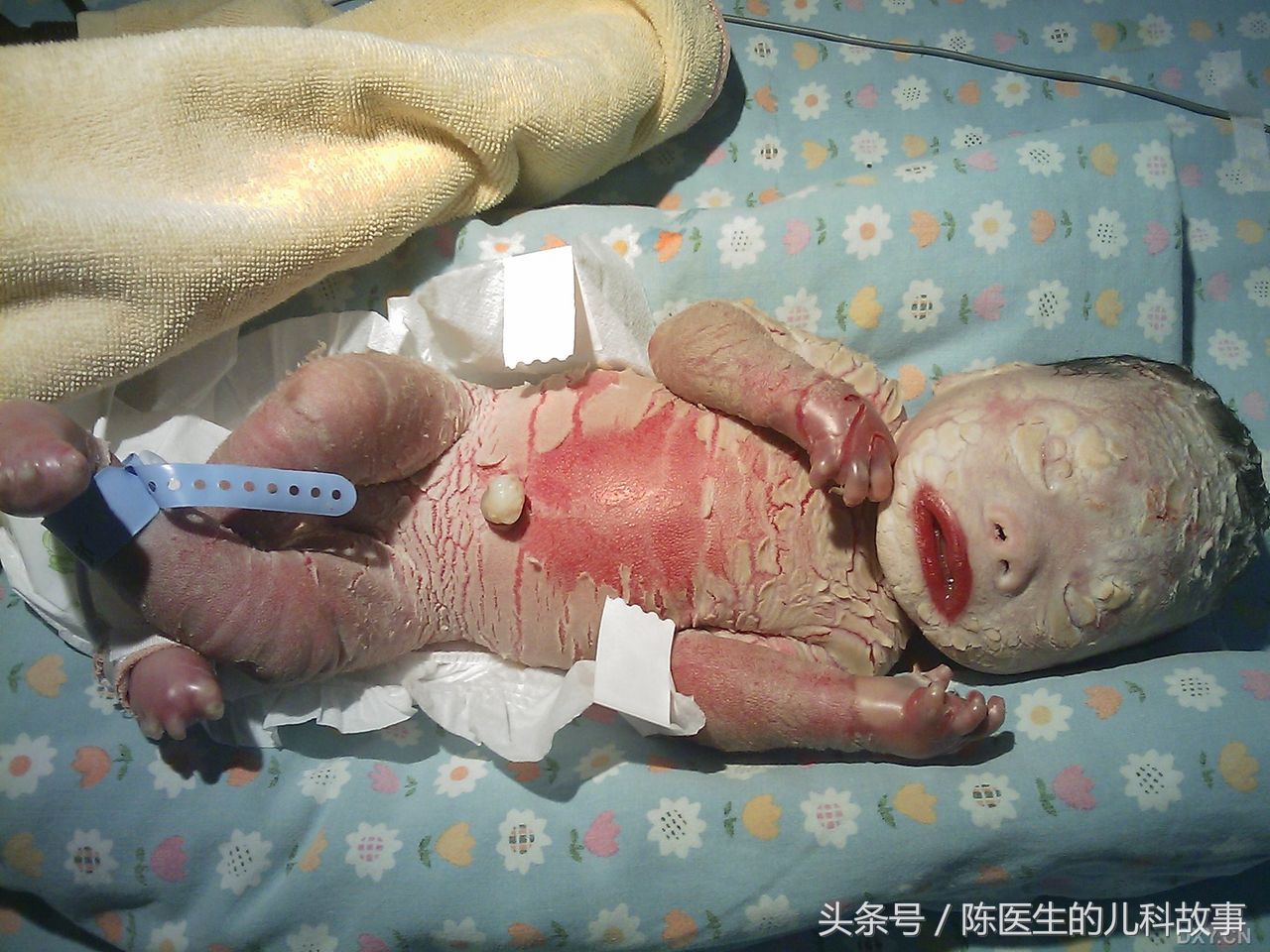 什么是火胶棉婴儿