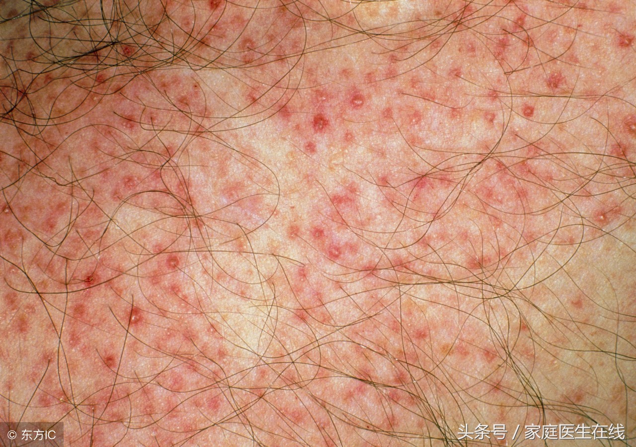 皮肤上长红色小点，不一定是痘痘，而是这个病！