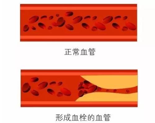 临床常用的各类止血药介绍-氨甲苯酸、酚磺乙胺等