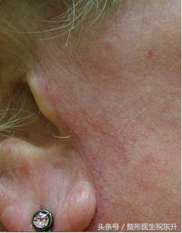 面部拉皮除皱为什么会导致耳朵变形呢