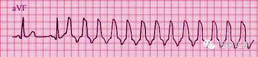 这么教你看心电图，还有什么理由看不懂？