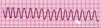 心电监护仪怎么看？教你如何看心电图！