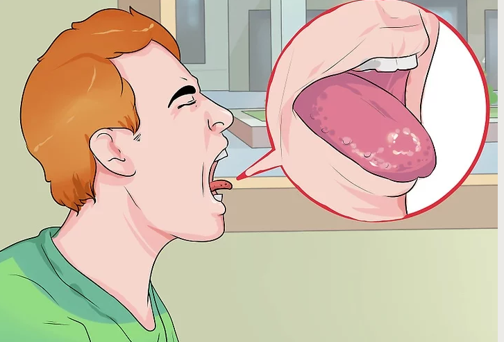 口腔溃疡总发作，你可能真的缺少这种维生素