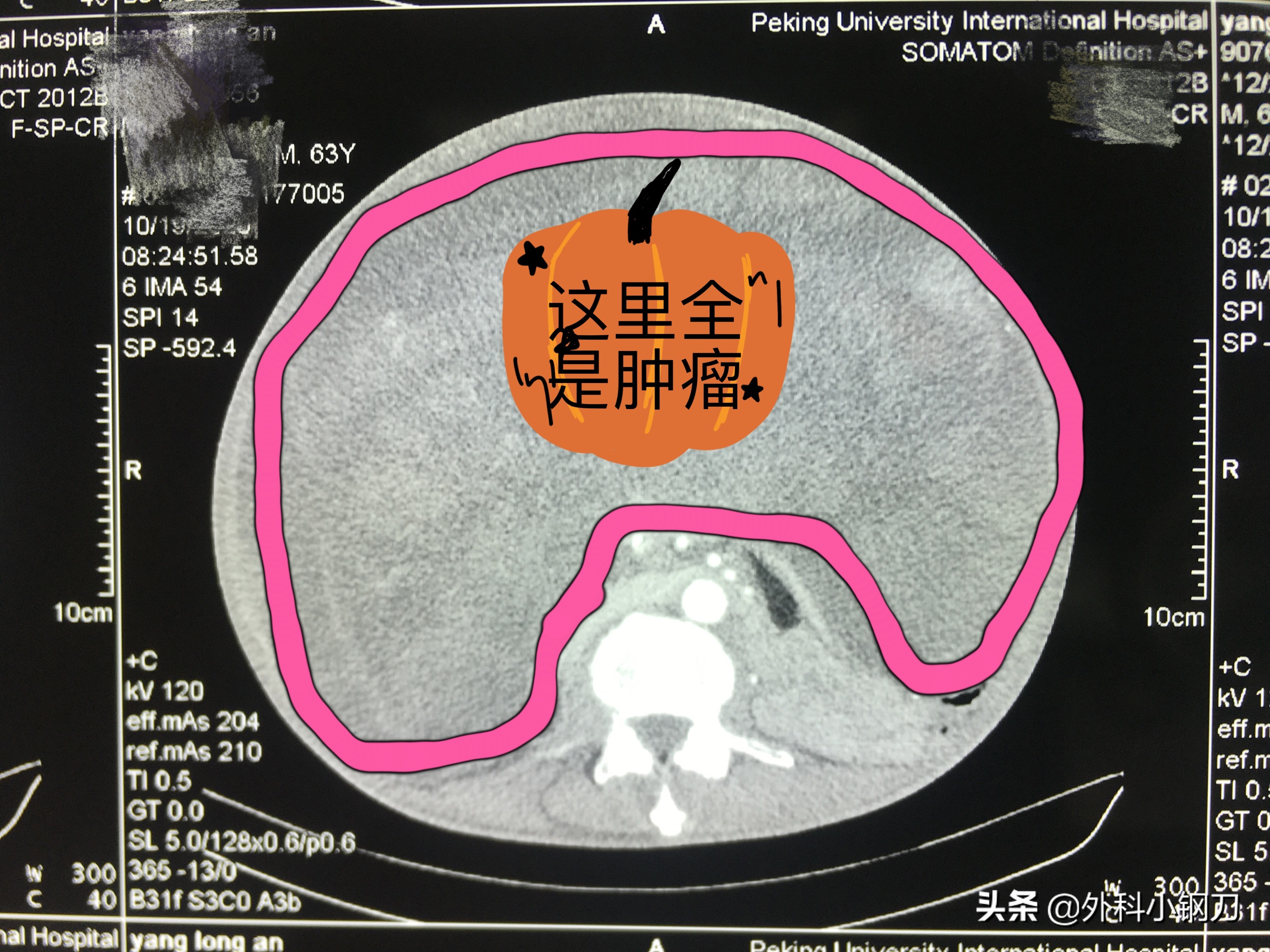 &ldquo;孕养&rdquo;两年30斤大瘤子怎么养成的，又是如何安全&ldquo;卸货&rdquo;的