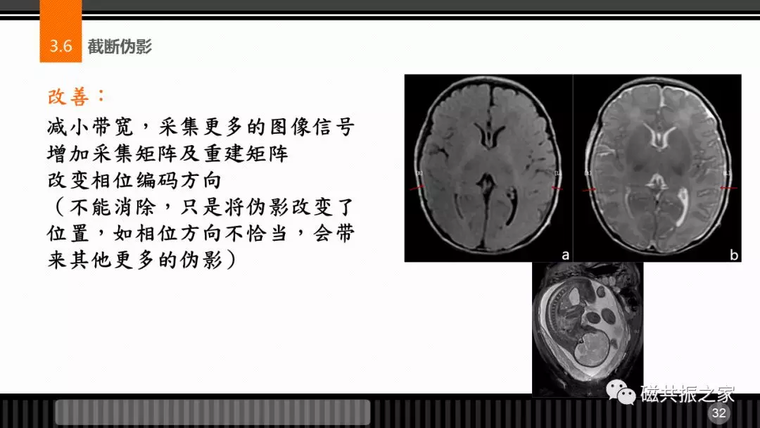 磁共振常见伪影及策略