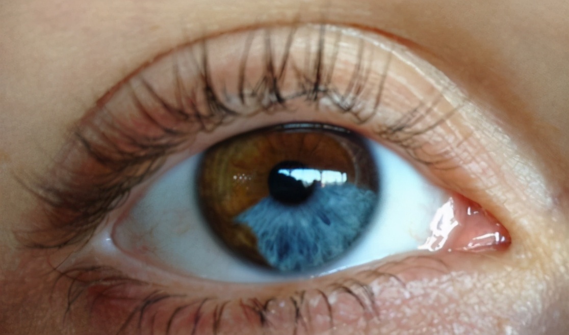 会引发异瞳状态的原因通常有两种.