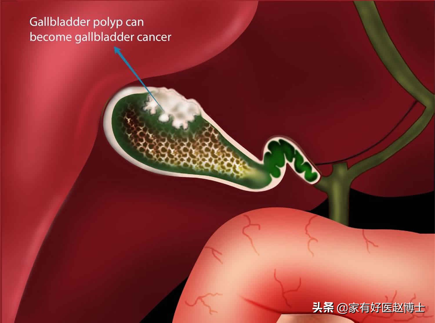 Why is it said that half of the gallbladder polyps are 