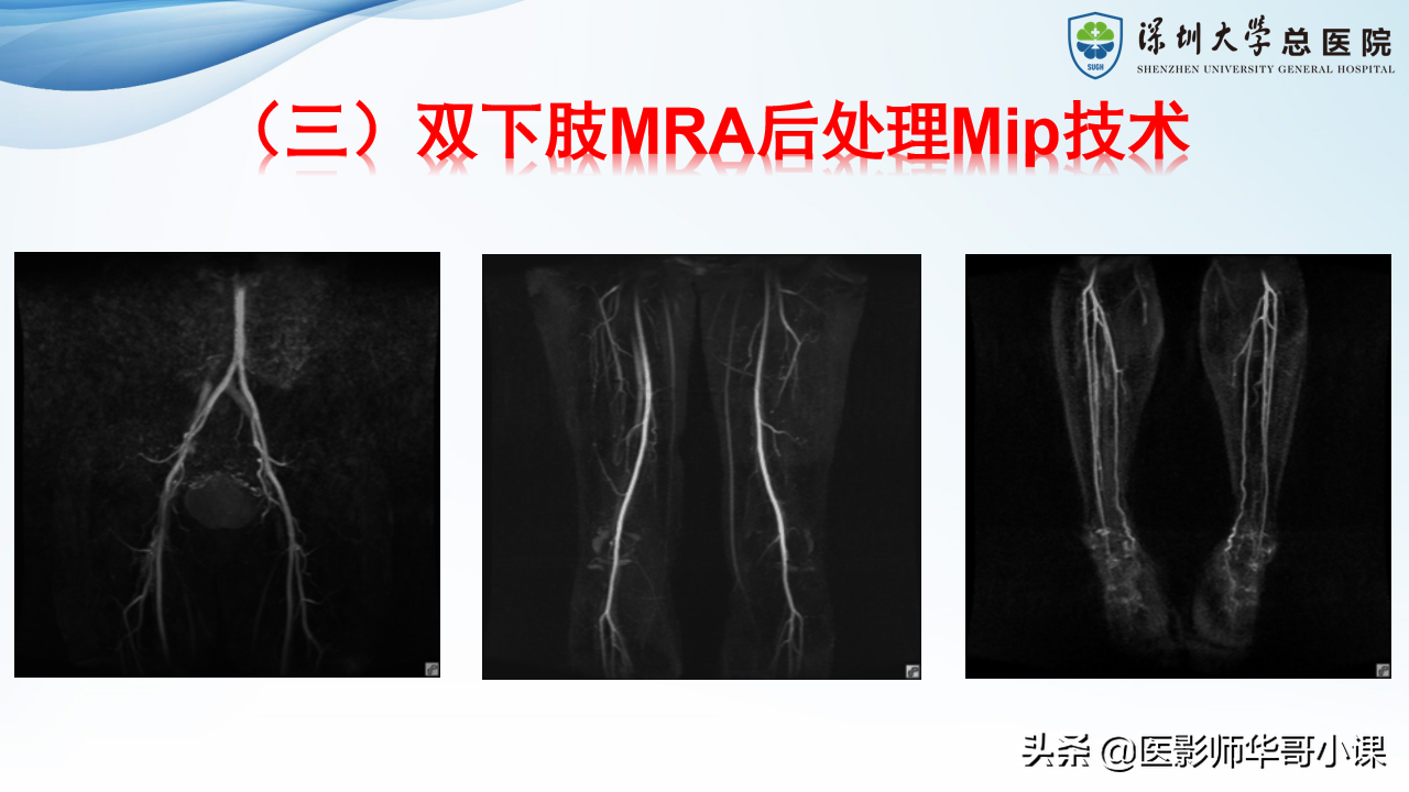 磁共振非增强双下肢血管MRA