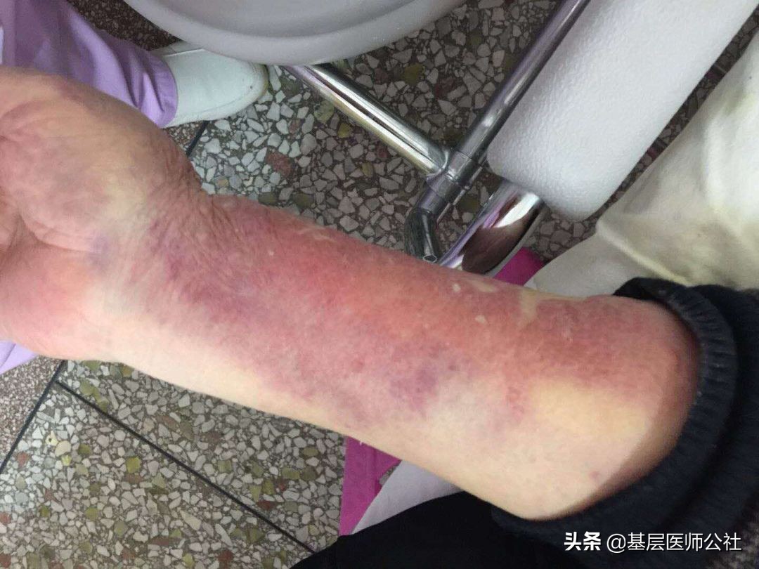 复方氨基酸注射液外渗水肿充血一大片，怎么办？