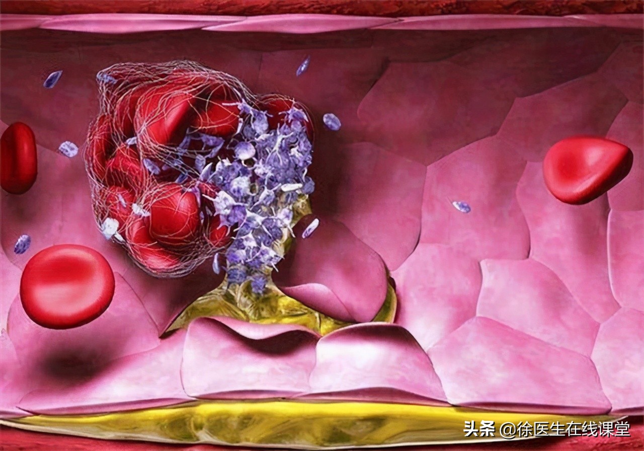 Clopidogrel is more expensive than aspirin, does it mean that it is