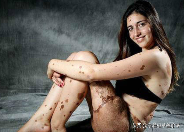 身上长有500多块胎记的女孩，曾被当怪物看待，