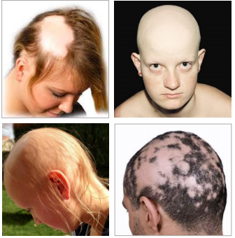 治疗斑秃的首个JAK抑制剂（巴瑞克替尼）试验成功：显著促进头发再生