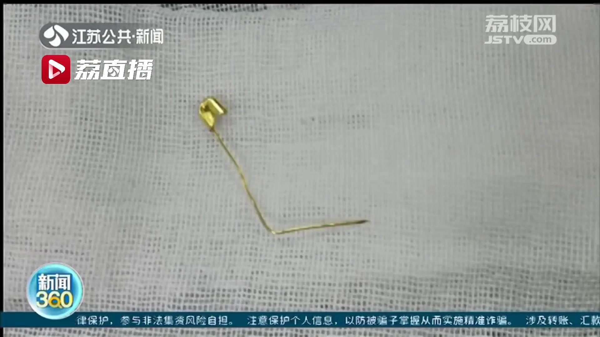 淮安一岁女童误吞别针 医生紧急手术取出