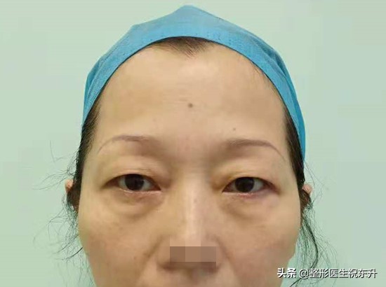 提眉手术什么年龄做合适？听说它与"割双眼皮"有相似之处...