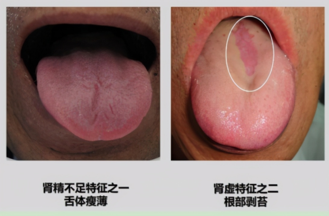 Deficiency of kidney yin and yang deficiency can not be distinguished ...