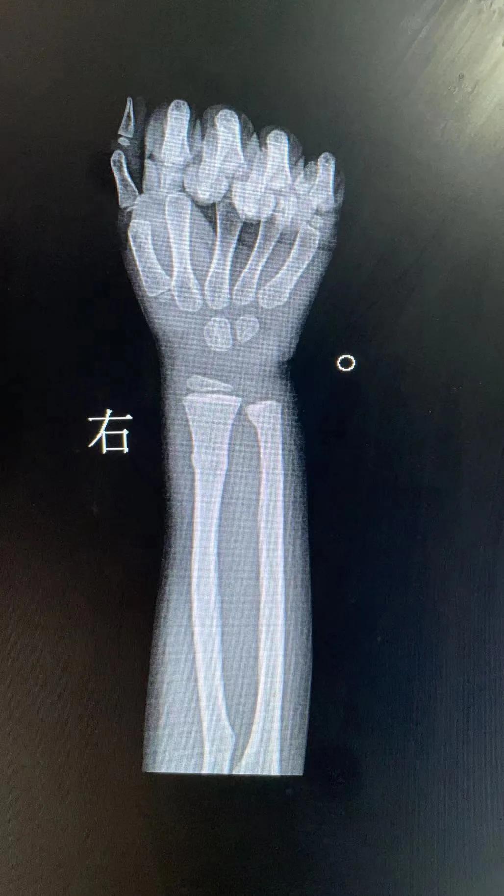 為什么小孩比較容易出現的青枝骨折,x光又該怎麼看怎麼診斷呢? - 資訊咖