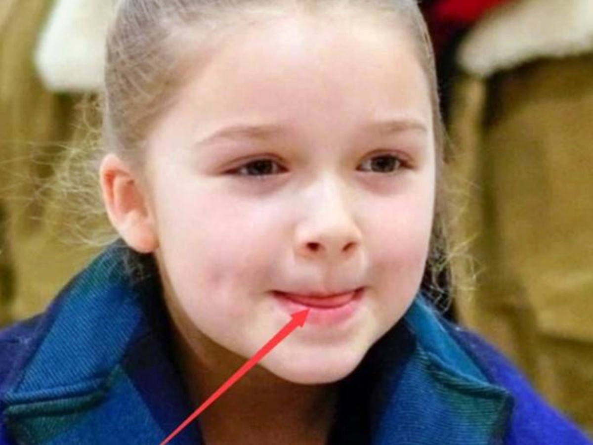 What should I do if my child has chapped lips, peeling and bleeding?The