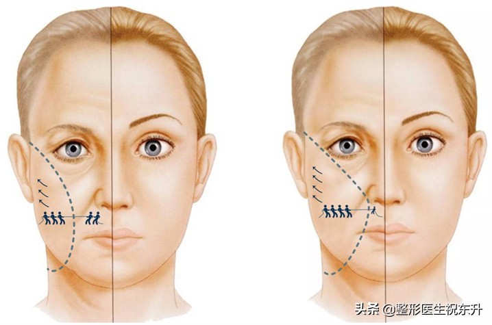 听医生与你讲：与“拉皮手术”相关的25个真相