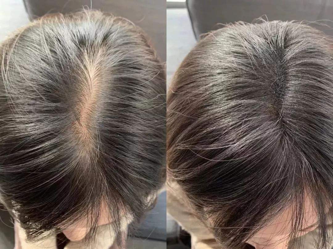 After shampooing with ginger and eating black sesame seeds, why do you still lose your hair