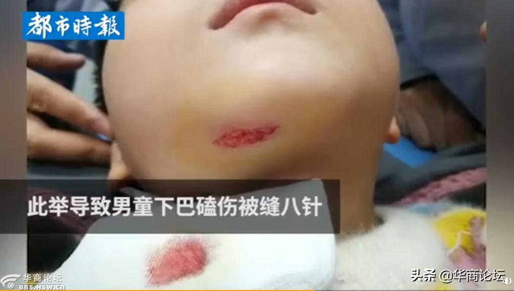 每日最陕西丨 西安一教师暴力拖摔幼童 致男童下巴缝8针