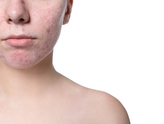 What Is Nodular Acne How To Get Rid Of Nodular Acne Inews 