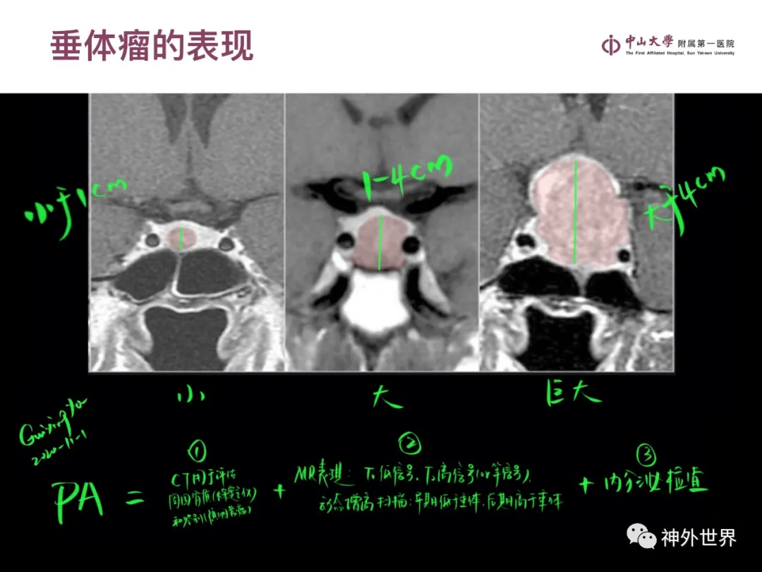 最全影像总结 | 颅内病变 MR、CT 的阅片技巧，太赞了