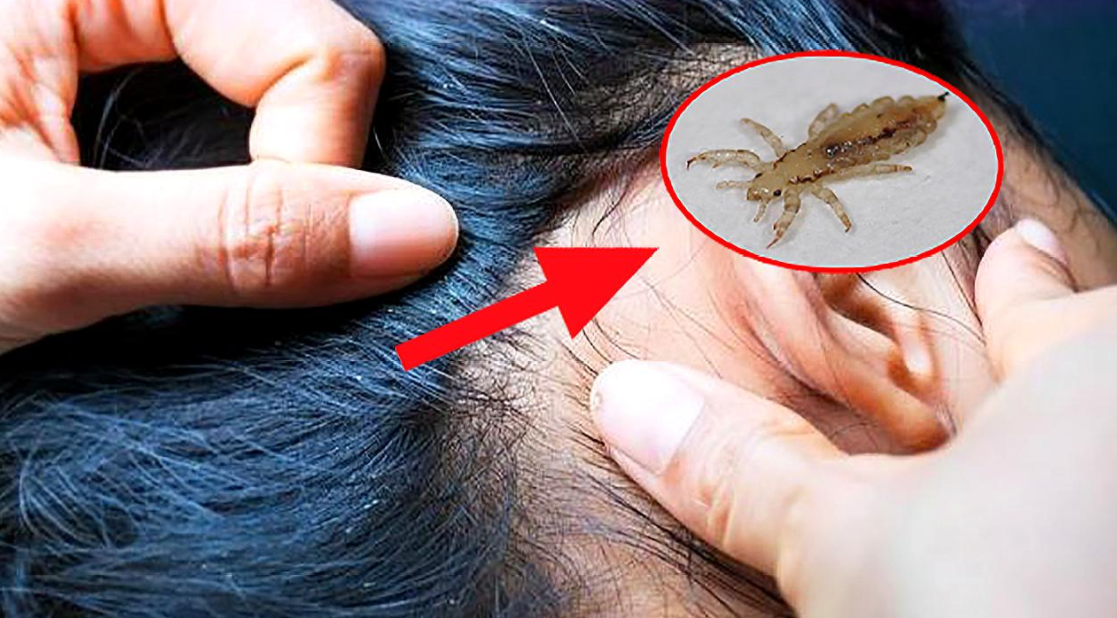 幾十年前農村很多人頭上都有蝨子 為何如今突然沒了 環球科學貓 Mdeditor