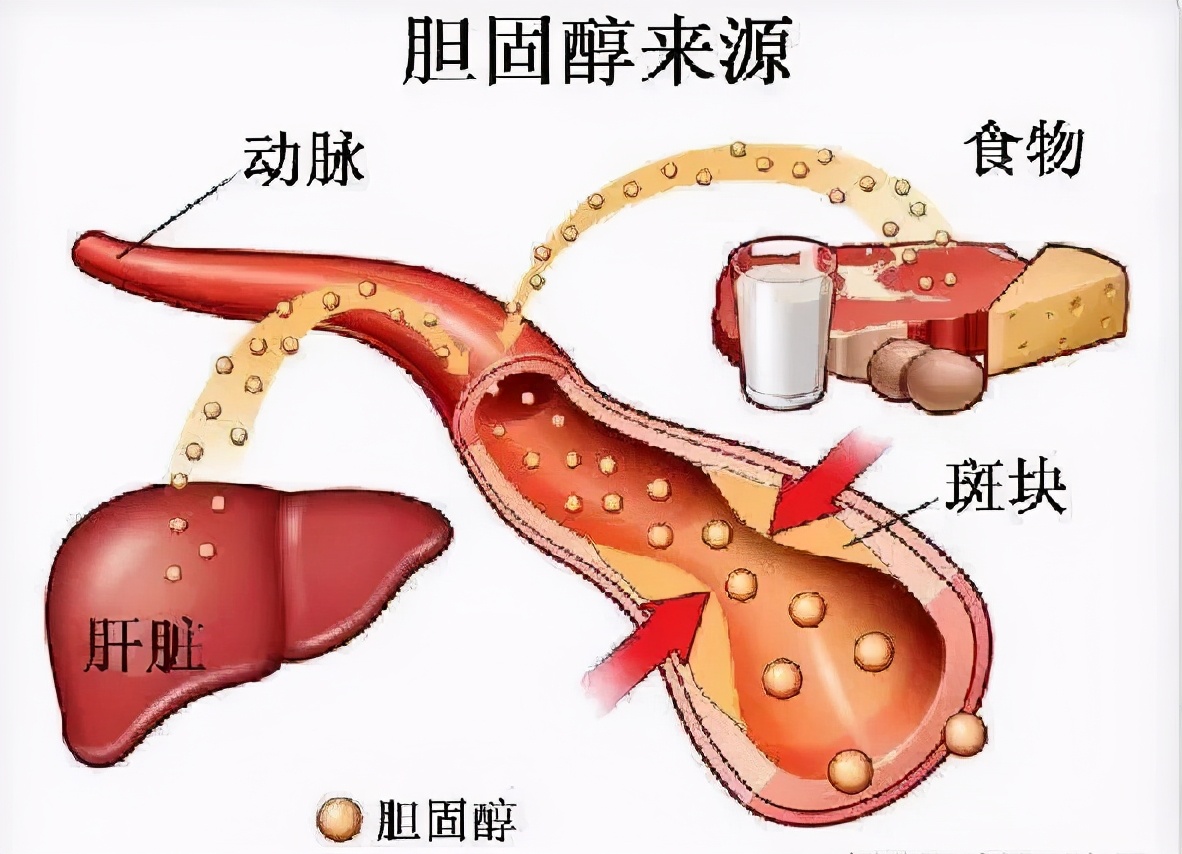 美国总统病逝，导致最大医学研究出炉：没有胆固醇，就没有冠心病