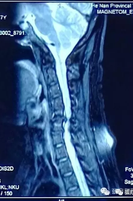 脊髓型颈椎病 一定要手术 脊髓型颈椎病