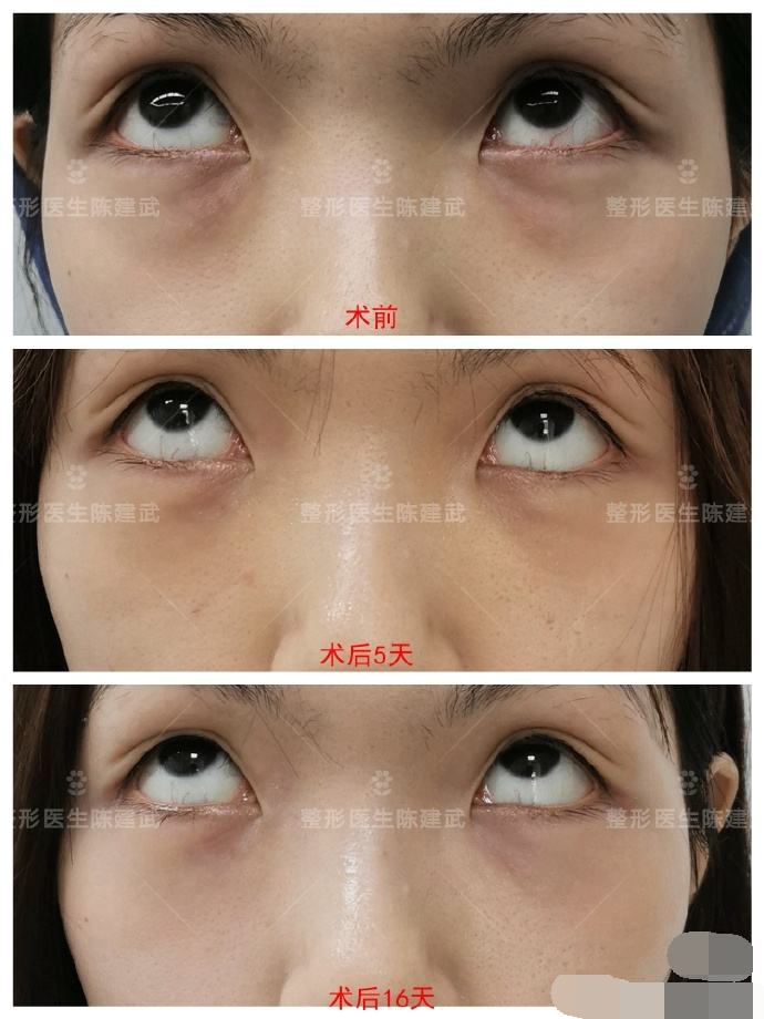 27岁女孩割眼袋 术后却还有黑眼圈 分享一下自己的亲身经历 整形医生陈建武 Mdeditor