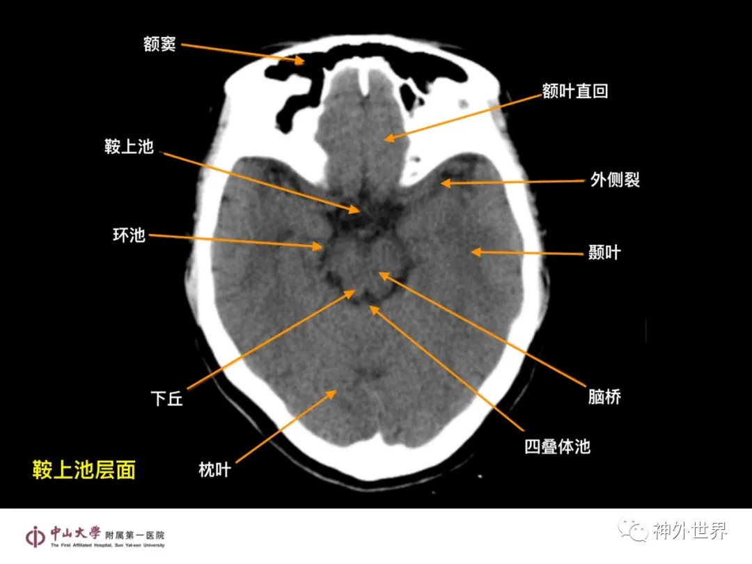 最全影像总结 | 颅内病变 MR、CT 的阅片技巧，太赞了