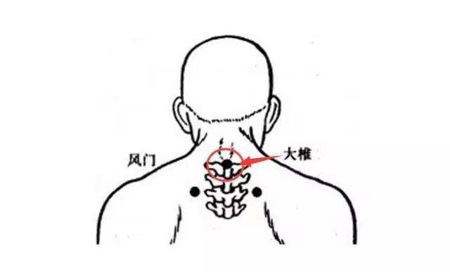 颈部如何刮痧颈椎病的刮痧治疗
