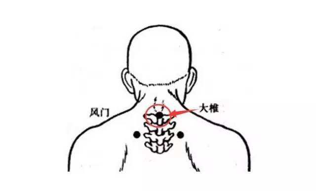 颈椎病的刮痧治疗