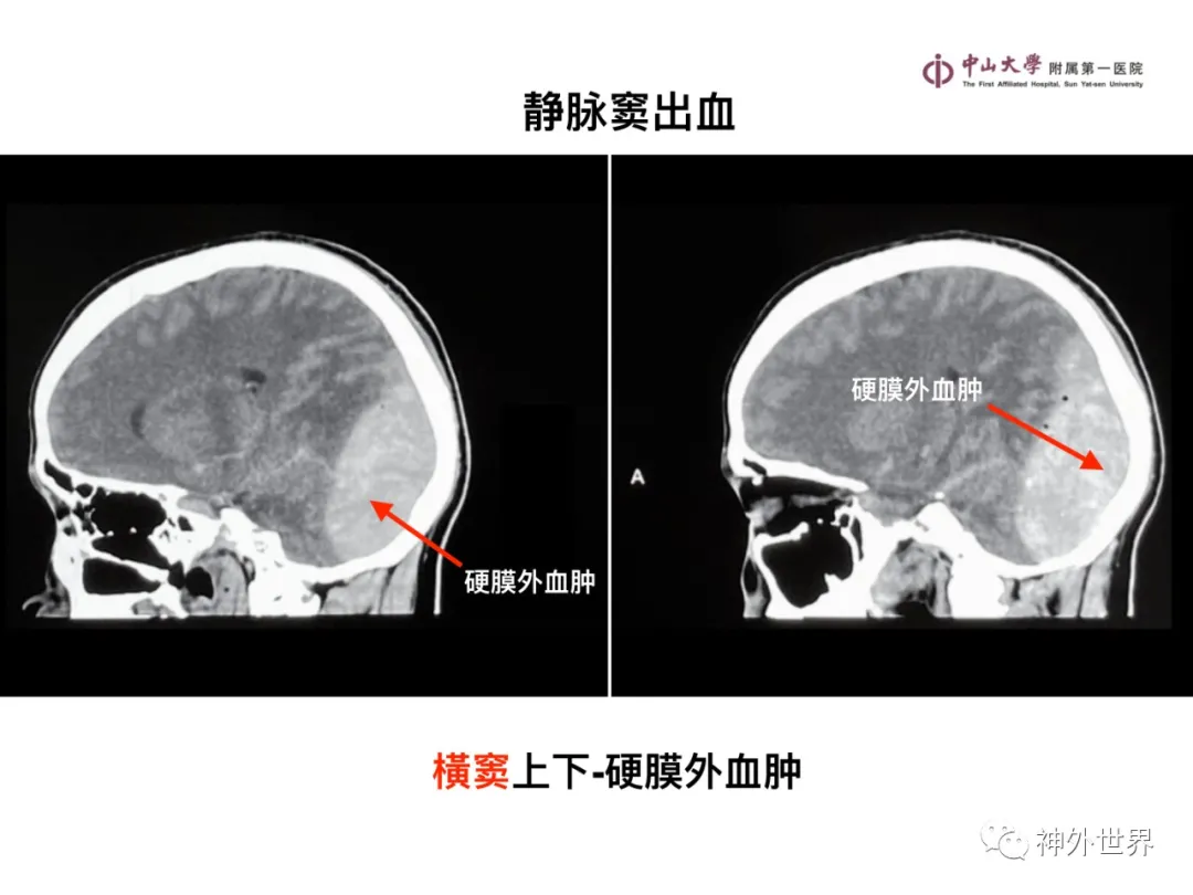 最全影像总结 | 颅内病变 MR、CT 的阅片技巧，太赞了