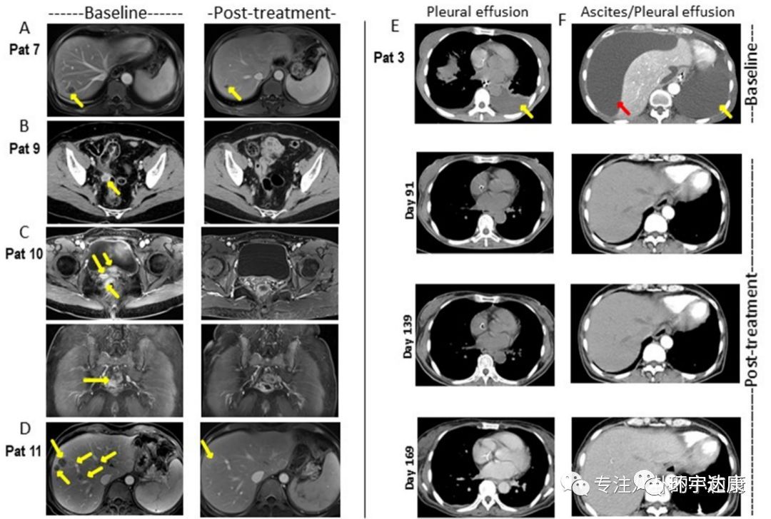 胃癌已上市的靶向和免疫药物