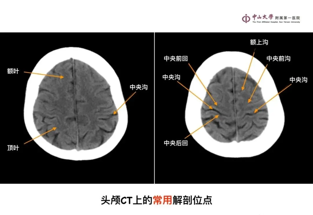 最全影像总结 | 颅内病变 MR、CT 的阅片技巧，太赞了