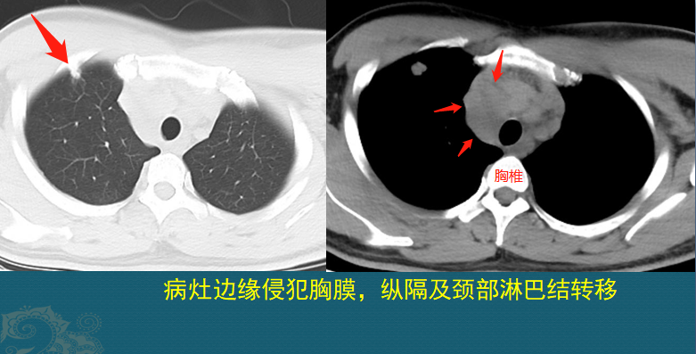 肺癌复发和转移的原因是什么？医生用2个病例，指导正确防癌