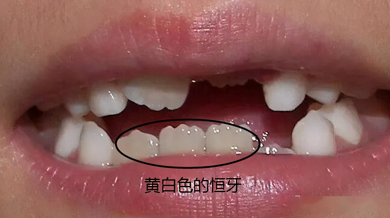 最全儿童换牙时间表：儿童换牙何时开始、何时结束？一图说清
