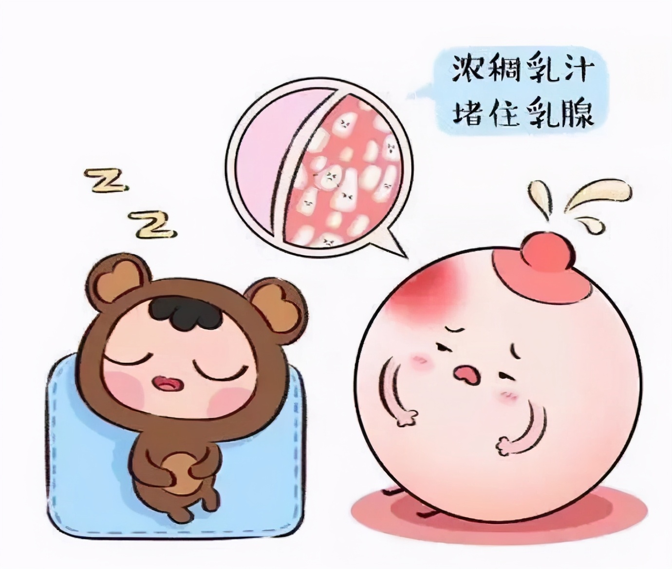 门诊小故事 哺乳期乳腺炎莫惊慌