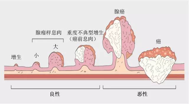 我叫肠息肉，大部分的肠癌都是由我演变而成，大家可别小看我哦